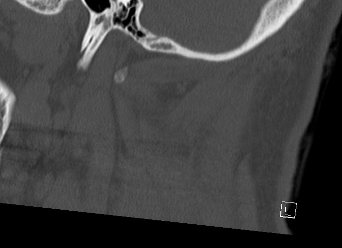 Chiari I malformation with a symptomatic syrinx of the posterolateral medulla oblongata (Radiopaedia 42573-45707 A 10).jpg