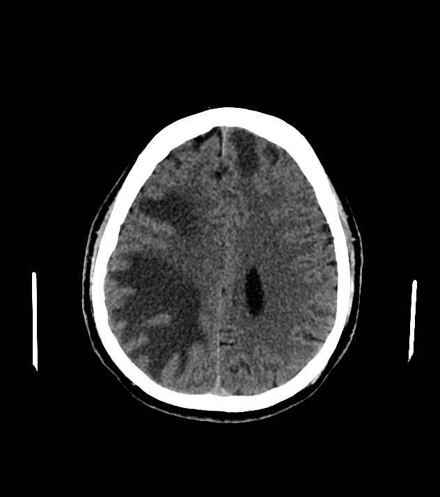 Cholangiocarcinoma with cerebral metastases (Radiopaedia 83519-98628 Axial non-contrast 46).jpg