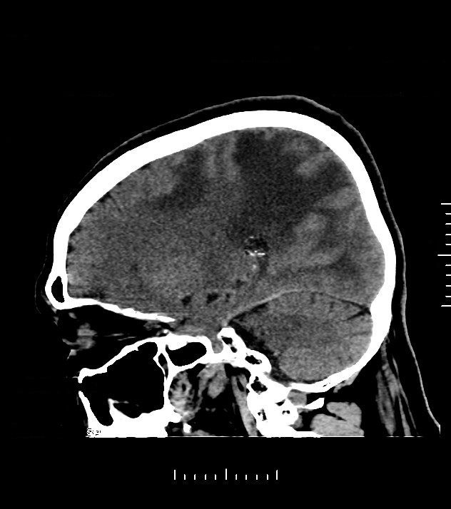 Cholangiocarcinoma with cerebral metastases (Radiopaedia 83519-98628 C 20).jpg