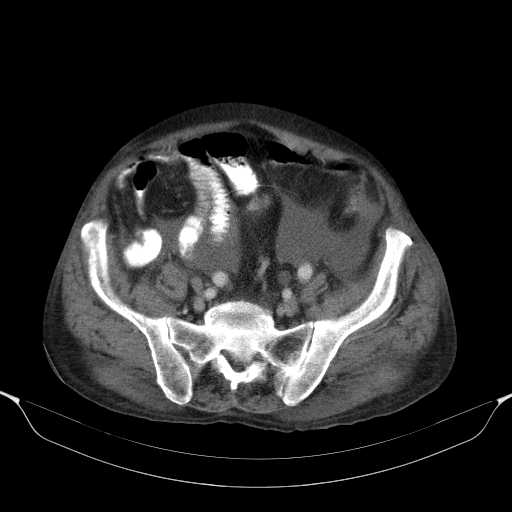 File:Cholangitis and abscess formation in a patient with cholangiocarcinoma (Radiopaedia 21194-21100 A 39).jpg
