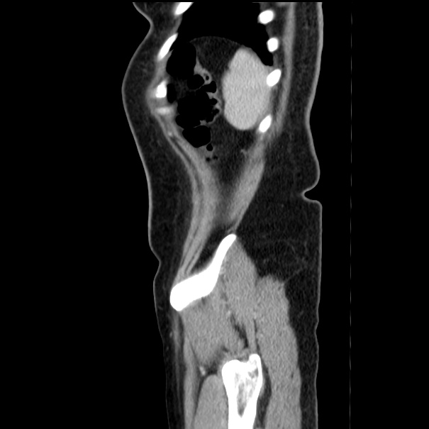 Choledocholithiasis on CT and MRI (Radiopaedia 24825-25087 D 57).jpg