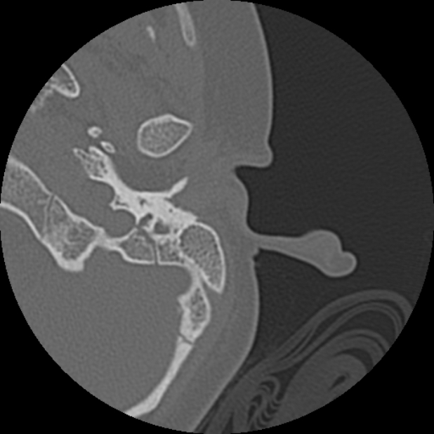 Cholesteatoma (Radiopaedia 73023-83750 Axial Left ear 3).jpg