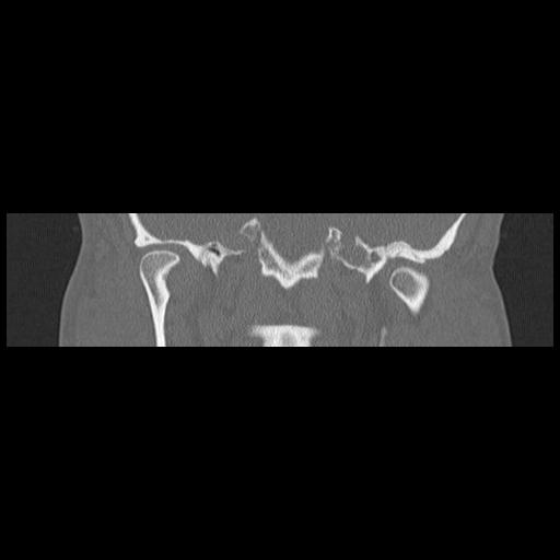 Cholesteatoma (Radiopaedia 84946-100455 Coronal bone window 88).jpg