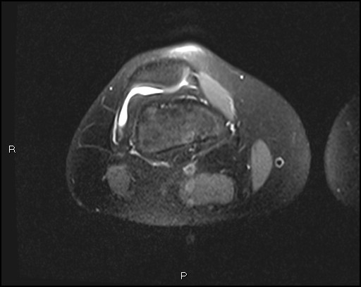File:Chondroblastoma (Radiopaedia 62721-71031 Axial PD fat sat 9).jpg