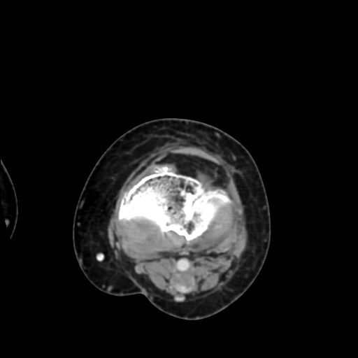 Chondrosarcoma - femur (Radiopaedia 64187-72954 Axial with contrast 59).jpg