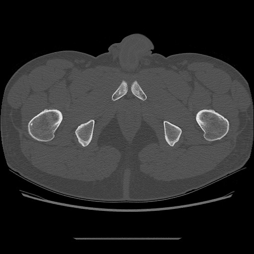 File:Chondrosarcoma of iliac wing (Radiopaedia 63861-72599 Axial bone window 122).jpg
