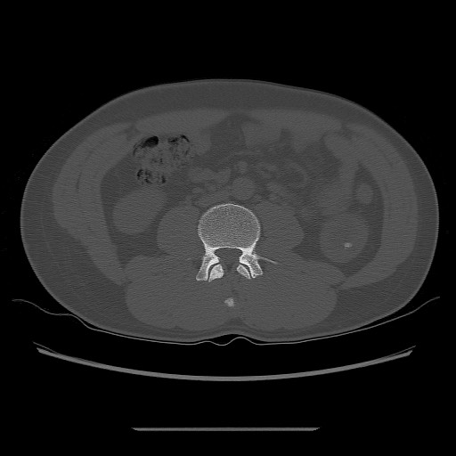 File:Chondrosarcoma of iliac wing (Radiopaedia 63861-72599 Axial bone window 3).jpg