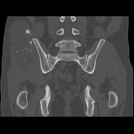 Chondrosarcoma of iliac wing (Radiopaedia 63861-72599 Coronal bone window 75).jpg