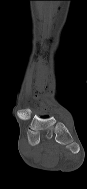 Chopart fracture (Radiopaedia 35347-36851 Coronal bone window 45).jpg