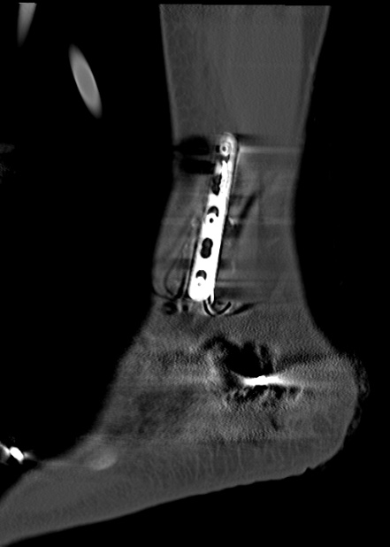Chopart fracture (Radiopaedia 35347-36861 Sagittal bone window 60).jpg