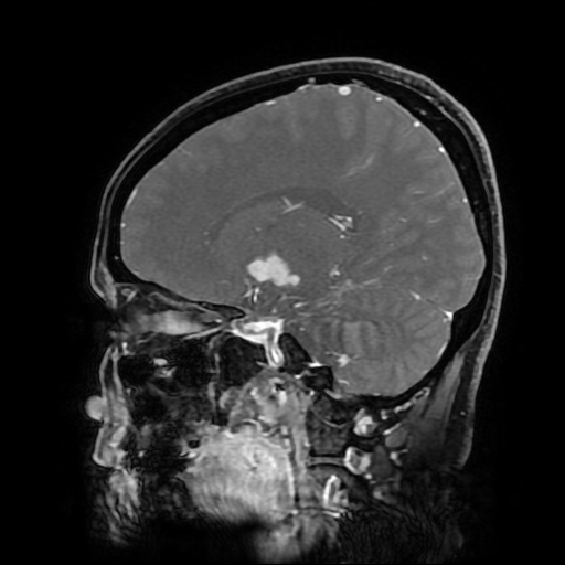 File:Chordoid glioma of third ventricle (Radiopaedia 91612-109340 F 126).jpg