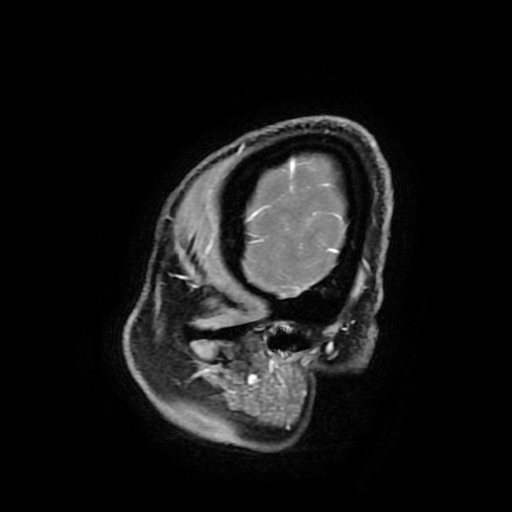 Chordoid glioma of third ventricle (Radiopaedia 91612-109340 F 187).jpg