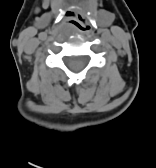 File:Chordoma (C4 vertebra) (Radiopaedia 47561-52188 Axial non-contrast 27).png