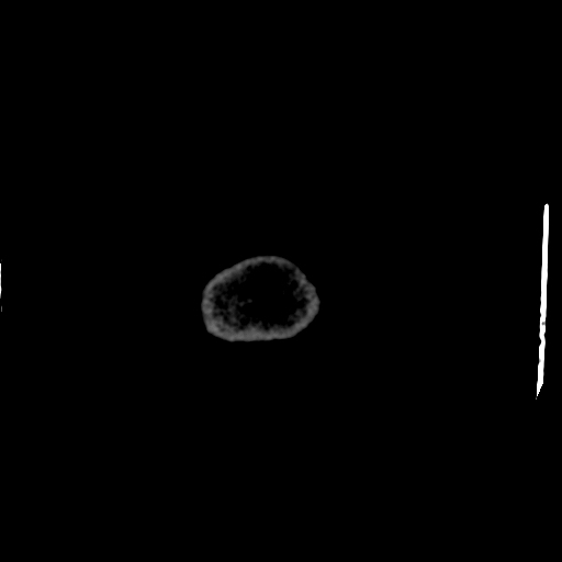 Choroid plexus xanthogranulomas (Radiopaedia 51621-57408 Axial non-contrast 123).jpg