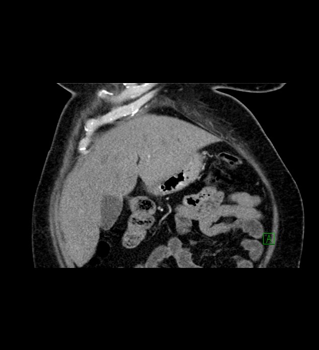 Chromophobe renal cell carcinoma (Radiopaedia 84239-99519 C 21).jpg