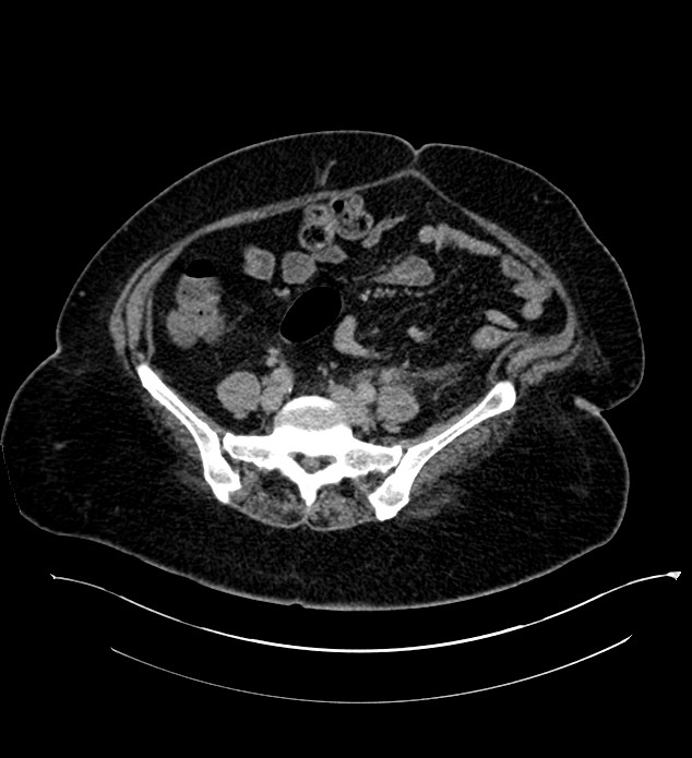 Chromophobe renal cell carcinoma (Radiopaedia 84239-99519 E 111).jpg