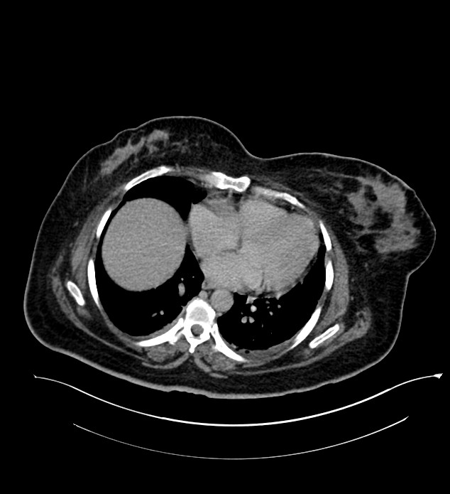 Chromophobe renal cell carcinoma (Radiopaedia 84239-99519 E 17).jpg