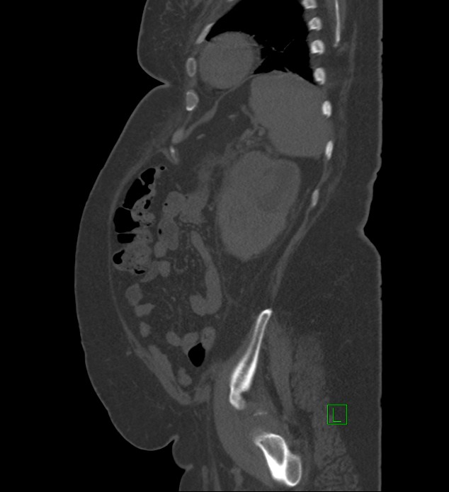 Chromophobe renal cell carcinoma (Radiopaedia 84239-99519 Sagittal bone window 21).jpg