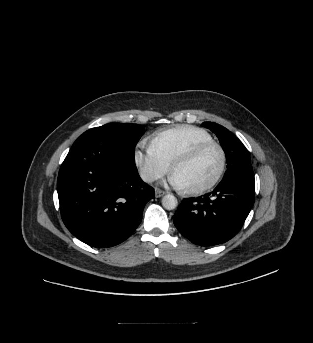 Chromophobe renal cell carcinoma (Radiopaedia 84337-99644 C 3).jpg