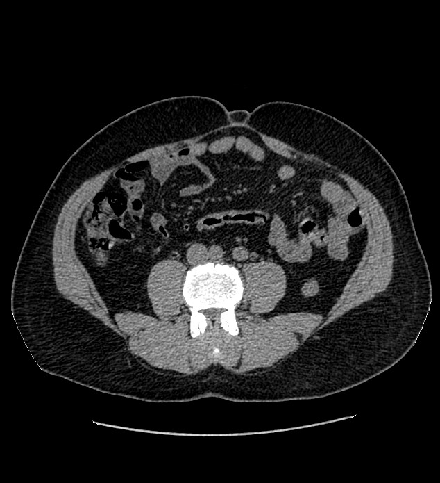 Chromophobe renal cell carcinoma (Radiopaedia 84337-99693 Axial non-contrast 89).jpg