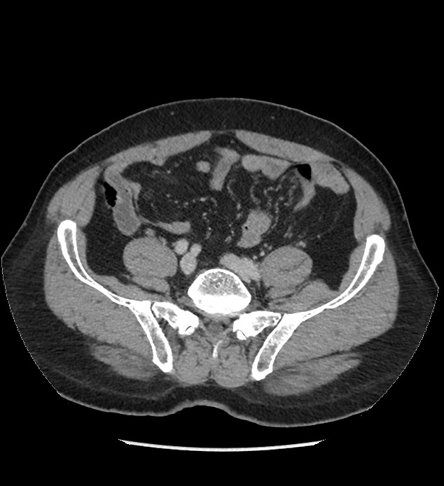Chromophobe renal cell carcinoma (Radiopaedia 86879-103083 C 108).jpg