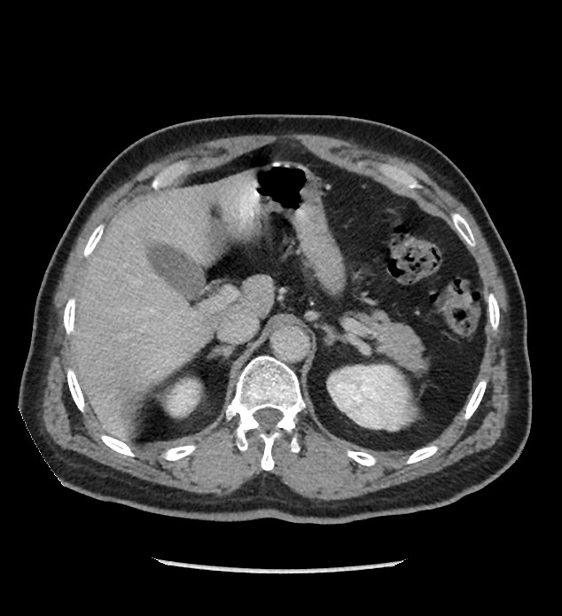 Chromophobe renal cell carcinoma (Radiopaedia 86879-103083 C 36).jpg