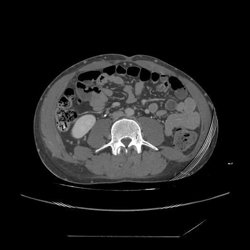 File:Chronic IVC thrombosis and resultant IVC filter malposition (Radiopaedia 81158-94800 A 128).jpg