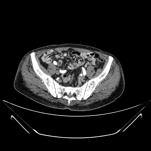 Chronic contained rupture of abdominal aortic aneurysm with extensive erosion of the vertebral bodies (Radiopaedia 55450-61901 A 60).jpg