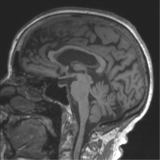 Chronic hypertensive encephalopathy (Radiopaedia 39993-42482 Sagittal T1 50).png