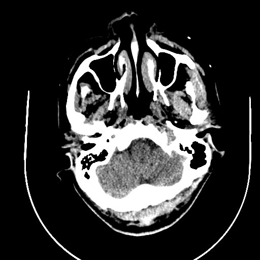 File:Chronic invasive fungal sinusitis (Radiopaedia 91563-109286 Axial non-contrast 5).jpg