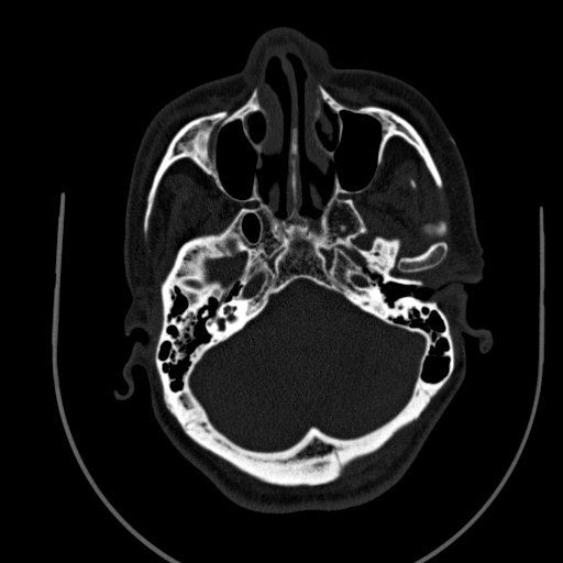 Chronic invasive fungal sinusitis (Radiopaedia 91563-109286 Axial sinus 35).jpg