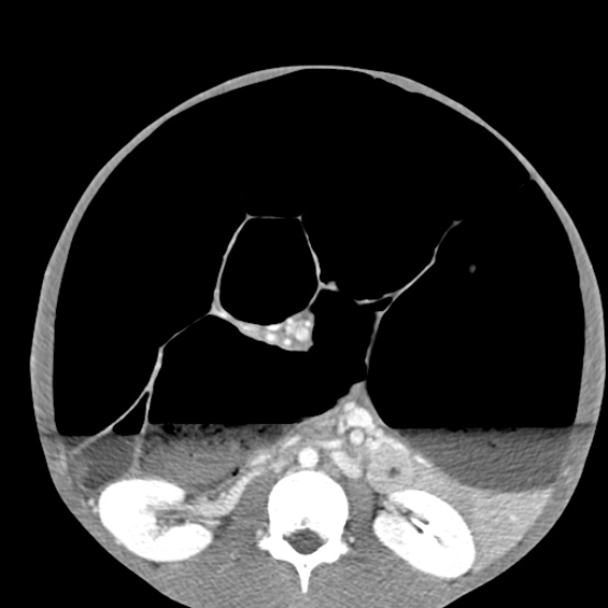 Chronic large bowel pseudo-obstruction (Radiopaedia 43181-46492 A 90).jpg