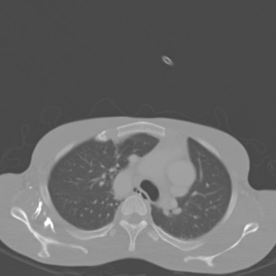 Chronic large bowel pseudo-obstruction (Radiopaedia 43181-46492 Axial bone window 1).jpg