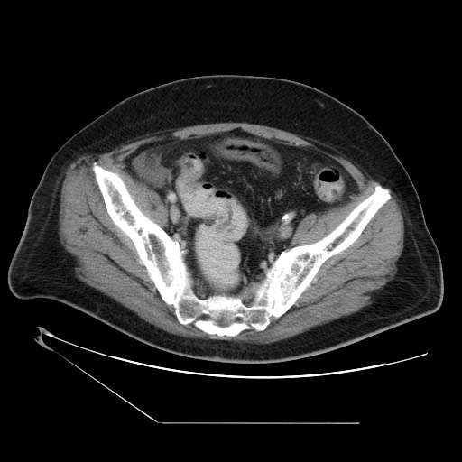 Chronic mesenteric ischemia - arterial (Radiopaedia 88205-104810 A 68).jpg
