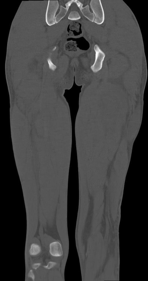 Chronic osteomyelitis (with sequestrum) (Radiopaedia 74813-85822 Coronal non-contrast 42).jpg