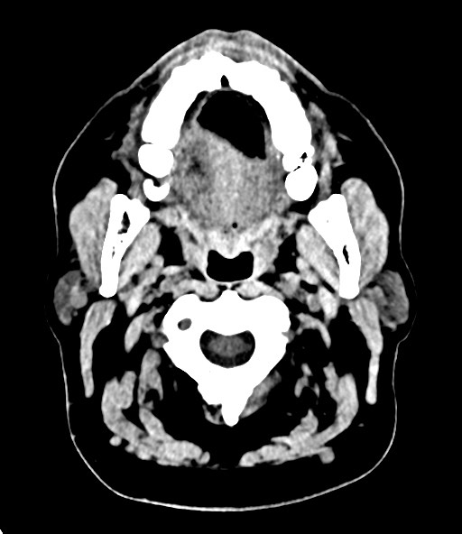 File:Chronic osteomyelitis - calvarial (severe) (Radiopaedia 69668-79616 Axial non-contrast 15).jpg