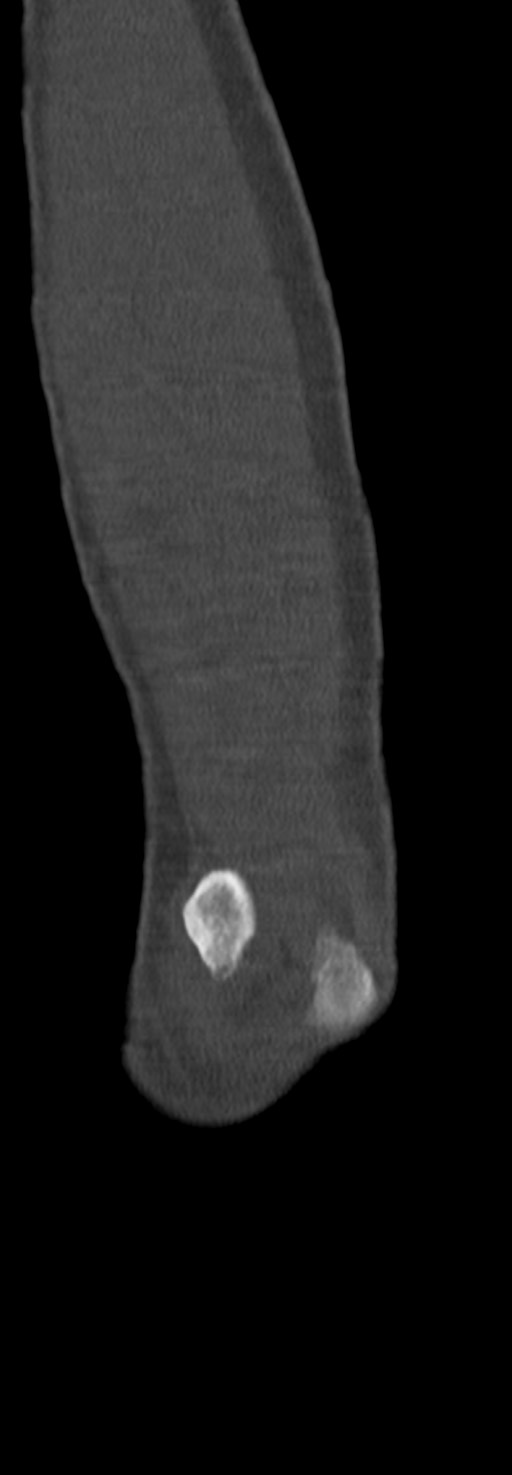 Chronic osteomyelitis of the distal humerus (Radiopaedia 78351-90971 Sagittal bone window 64).jpg
