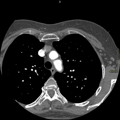 Chronic pulmonary embolism (Radiopaedia 73073-85094 Axial C+ CTPA 13).jpg