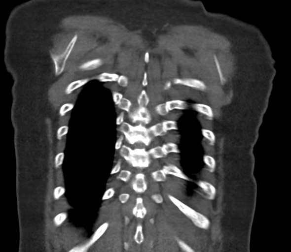 File:Chronic pulmonary embolus (Radiopaedia 39129-41341 Coronal C+ CTPA 74).png