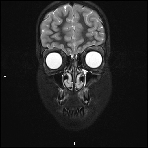 File:Chronic reactive multifocal osteomyelitis (CRMO) - mandible (Radiopaedia 56405-63069 Coronal STIR 8).jpg
