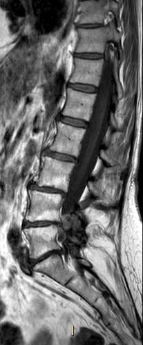 File:Chronic spinal hematoma with cauda equina syndrome (Radiopaedia 75745-87090 Sagittal T1 7).png