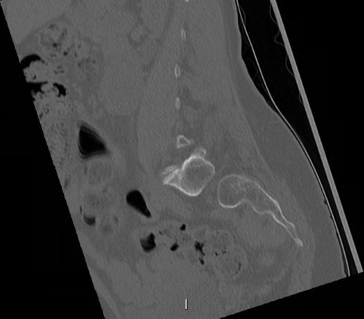 File:Chronic spinal hematoma with cauda equina syndrome (Radiopaedia 75745-88197 Sagittal bone window 5).png