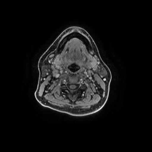 Chronic submandibular sialadenitis (Radiopaedia 61852-69885 Axial T1 C+ fat sat 56).jpg