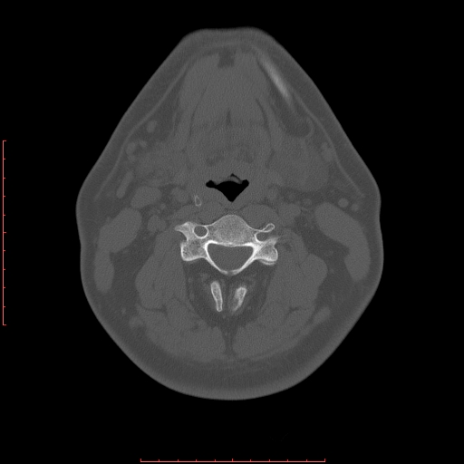 File:Chronic submandibular sialolithiasis (Radiopaedia 69817-79814 Axial bone window 88).jpg