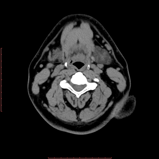 Chronic submandibular sialolithiasis (Radiopaedia 69817-79814 Axial non-contrast 130).jpg