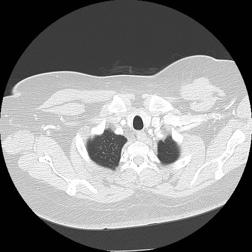 File:Cicatrisation collapse (Radiopaedia 17405-17089 lung window 12).jpg