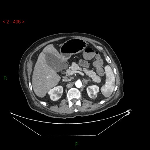 File:Circumaortic left renal vein and doubled left renal arteries (Radiopaedia 52268-58158 A 31).jpg