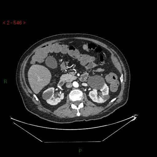 Circumaortic left renal vein and doubled left renal arteries (Radiopaedia 52268-58158 A 82).jpg