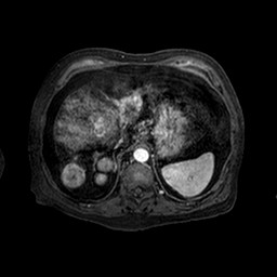 Cirrhosis and hepatocellular carcinoma in the setting of hemochromatosis (Radiopaedia 75394-86594 Axial T1 C+ fat sat 139).jpg