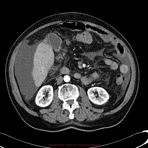 File:Cirrhosis and hepatocellular carcinoma in the setting of hemochromatosis (Radiopaedia 75394-86595 A 44).jpg